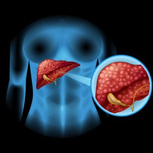 Prevención de cáncer de páncreas con IECED