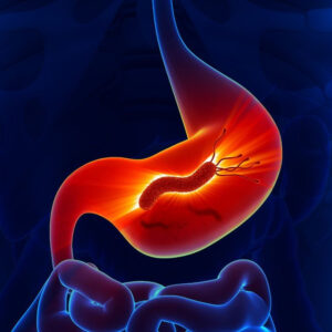 Prevención gastritis con IECED
